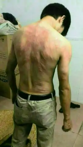 被跳蚤咬的症状图片有哪些(人被跳蚤咬了症状图片)-第1张图片-波音达百科