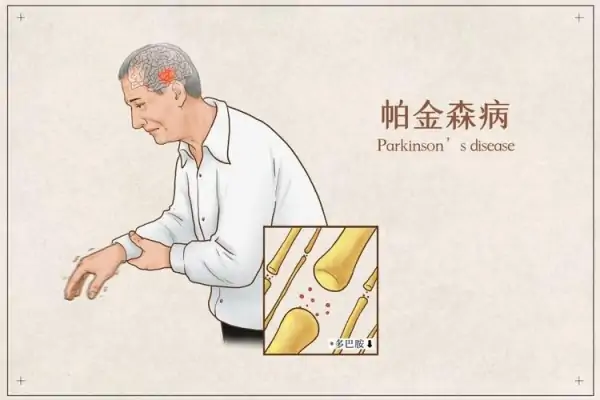 神经退行性疾病伴脑铁沉积6型是什么病?神经退行性疾病具体有哪些?-第6张图片-波音达百科