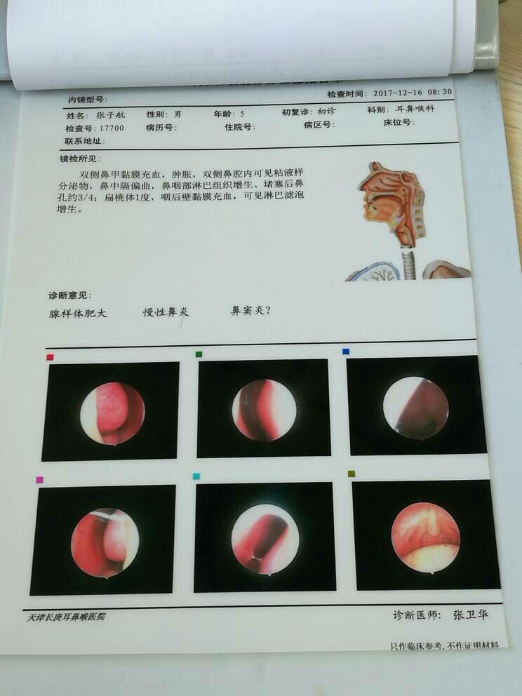 什么叫腺样体肥大(腺样体肥大有什么表现?)-第1张图片-波音达百科
