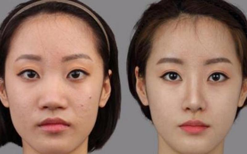 蒜头鼻整形前后对比-第1张图片-波音达百科