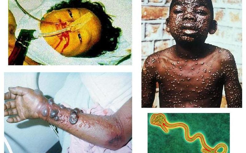 埃博拉病毒是哪一年发生的-第1张图片-波音达百科