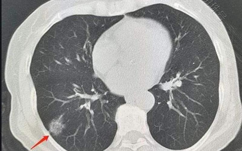 北京科兴肺结节是真的吗-第1张图片-波音达百科