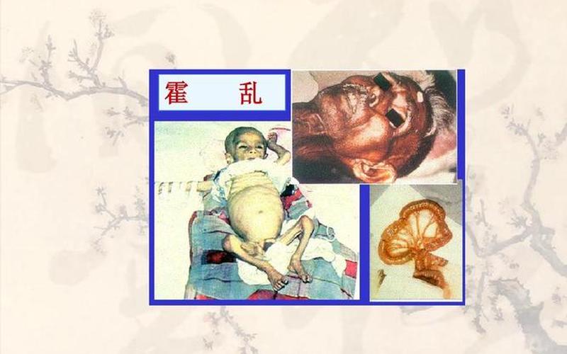 霍乱为何会被列为甲类传染病-第1张图片-波音达百科