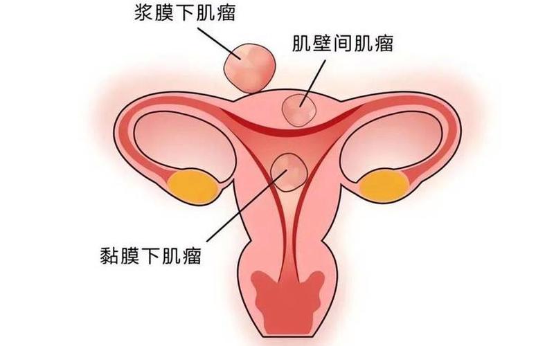 子宫肌瘤患者最主要的症状是-第1张图片-波音达手游百科
