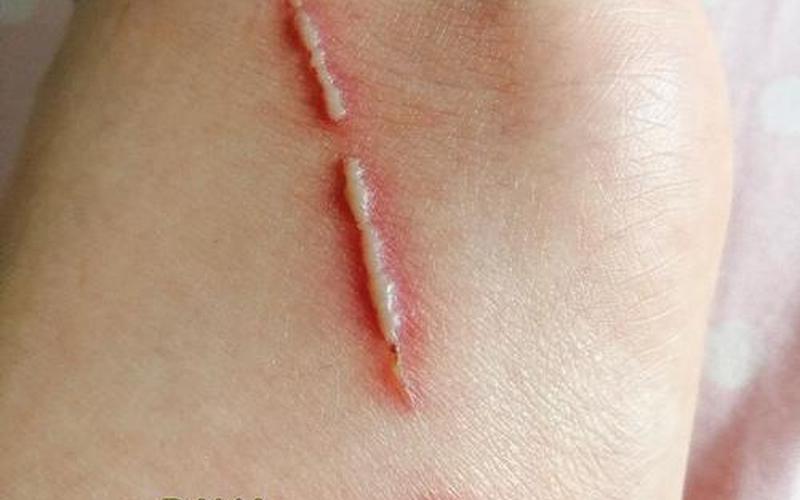 隐翅虫咬后最有效的处理 *** -第1张图片-波音达百科