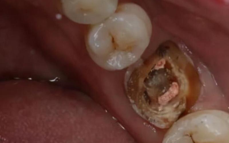 牙根腐烂长期不拔好吗-第1张图片-波音达百科