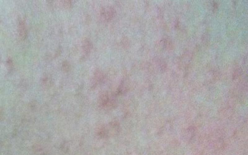 身上起红疙瘩还特别痒是什么原因-第1张图片-波音达百科