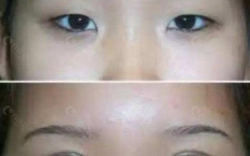 割双眼皮前后对比图-第1张图片-波音达手游百科