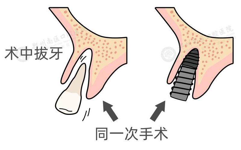 拔牙后多久可以献血-第1张图片-波音达百科