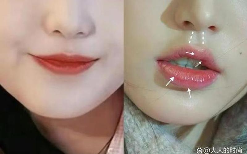 胶原蛋白丰唇好吗-第1张图片-波音达百科