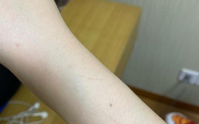 被猫抓了一下轻微破皮要打针吗-第1张图片-波音达百科