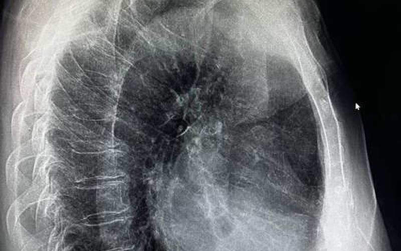 胸片曝光大全图片-第1张图片-波音达百科