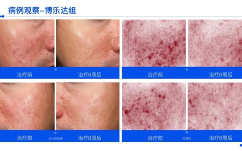 治疗痤疮的更好的医院-第1张图片-波音达百科