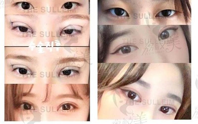 做个埋线双眼皮多少钱-第1张图片-波音达百科