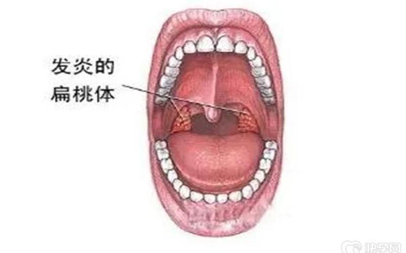 扁桃体发炎最快治愈法-第1张图片-波音达百科