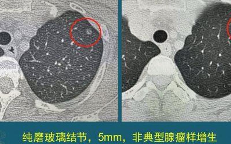 科兴中维肺结节是真的吗-第1张图片-波音达手游百科