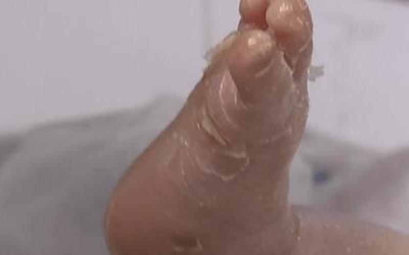 火棉胶宝宝长大正常吗-第1张图片-波音达百科