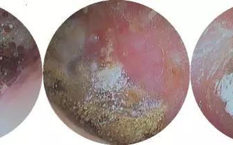 耳念珠菌感染的症状-第1张图片-波音达百科