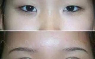 割双眼皮前后对比图