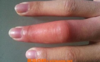 蜜蜂蛰消肿的最快 *** 