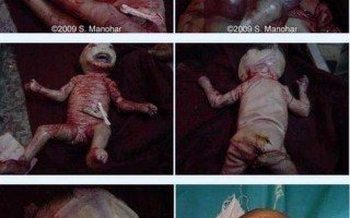 火棉胶婴儿什么意思