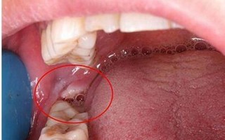 拔智齿后那个洞臭到恶心