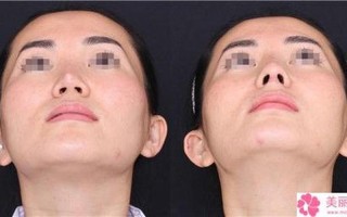 膨体隆鼻收多少钱