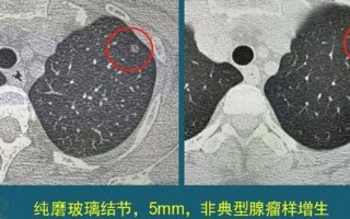 科兴中维肺结节是真的吗