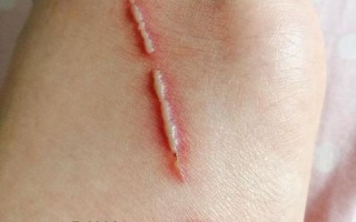 隐翅虫咬后最有效的处理 *** 