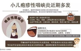 咽颊炎有什么症状如何治疗