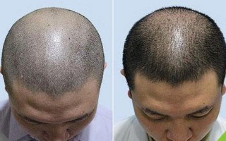 种头发的手术过程