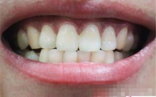 整形鼻子需要多少钱