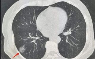 北京科兴肺结节是真的吗