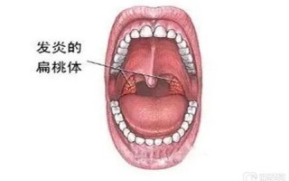 扁桃体发炎最快治愈法