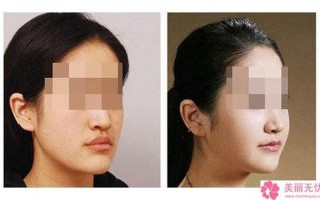 北京玻尿酸隆鼻需要多少钱