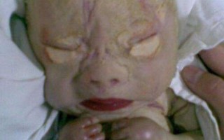 火棉胶婴儿会很痛苦吗