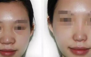 鼻翼缩小手术对比图
