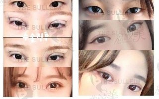 做个埋线双眼皮多少钱