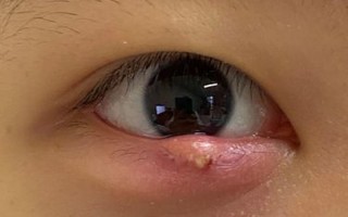 麦粒肿刚开始的图片