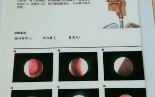什么叫腺样体肥大(腺样体肥大有什么表现?)
