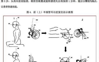 耳石症快速自愈 *** 