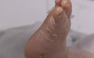 火棉胶宝宝长大正常吗