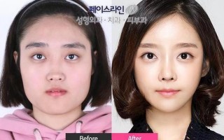去韩国整形要多少钱