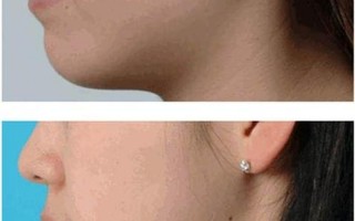 北京玻尿酸隆鼻多少钱