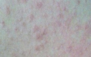 身上起红疙瘩还特别痒是什么原因